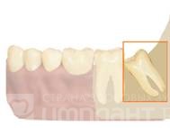 Описание: Дистопированный зуб мудрости